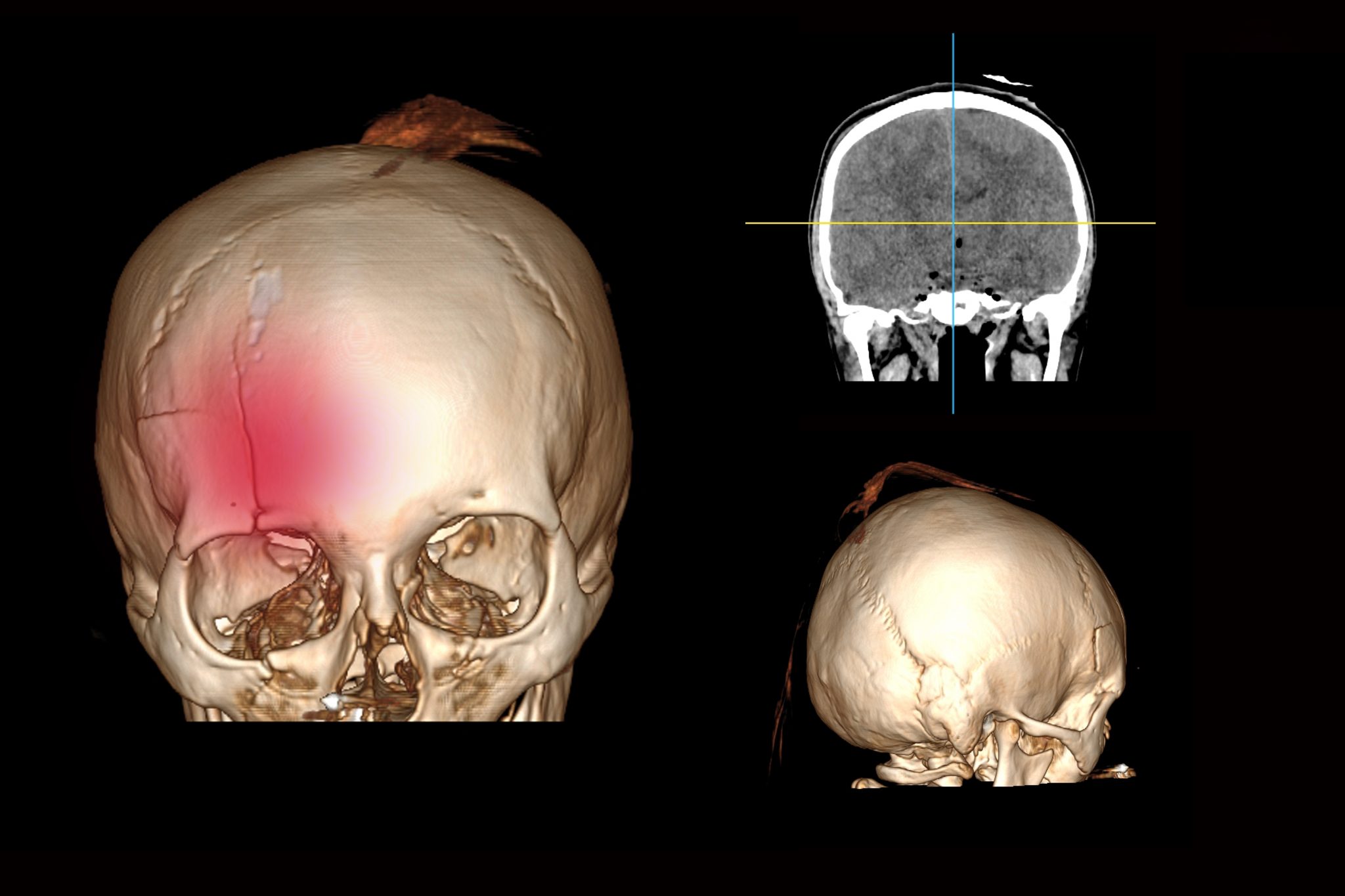 Skull Fracture Ultrasound Archives CE4RT