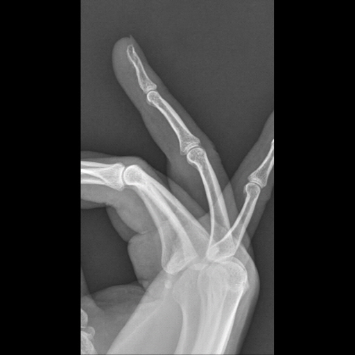 Lateral Finger X-Ray