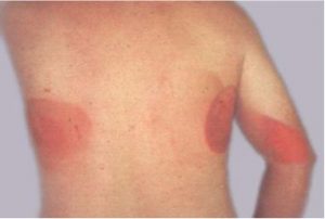 burn from large radiation dose 