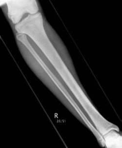 Radiographic Positioning of the Femur and Tib Fib- CE4RT