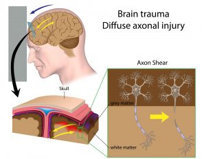 Brain trauma with diffuse axon shear injury