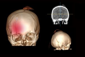 Brain with a fracture of the frontal part of the skull