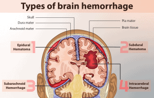 Brain Hemorrhage