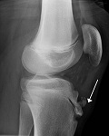 OsgoodSchlatter