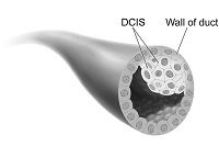 ductal carcinoma in situ