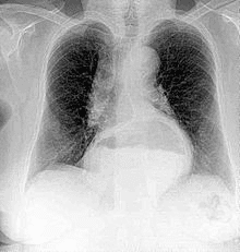 chest xray