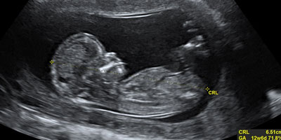 Ultrasound image showing developing fetus