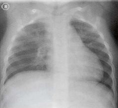 A) Chest x-ray of the propositus: cone-shaped chest, clavicular
