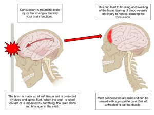 Concussion of brain