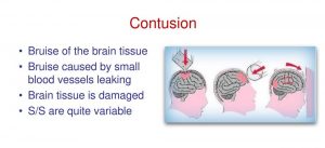 Contusion Bruise of the brain tissue 