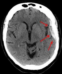 Ct-scan of the brain