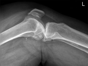 Malpositioned knee in rolled lateral projection