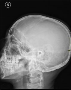 X-ray of the head