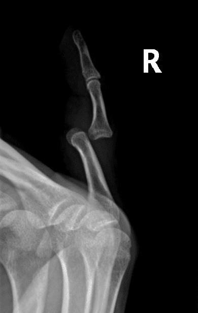 Dislocated Finger XRay