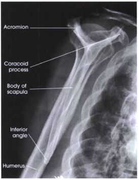 CE4RT - Radiographic Positioning of the Shoulder for X-ray Techs