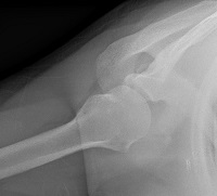 CE4RT - Radiographic Positioning of the Shoulder for X-ray Techs