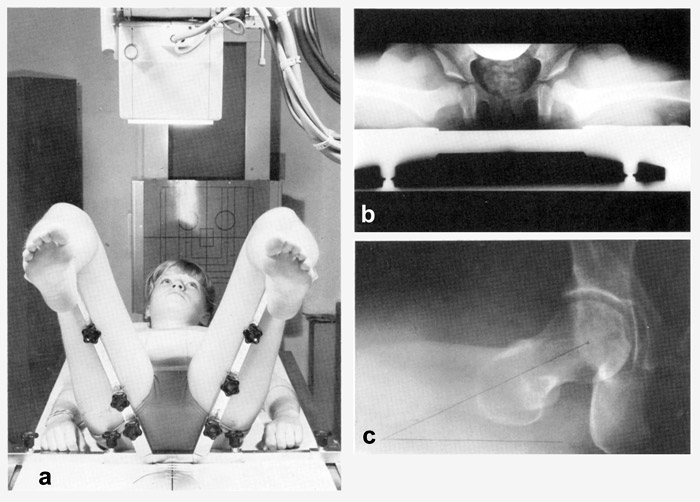 hip radiograph dunn view