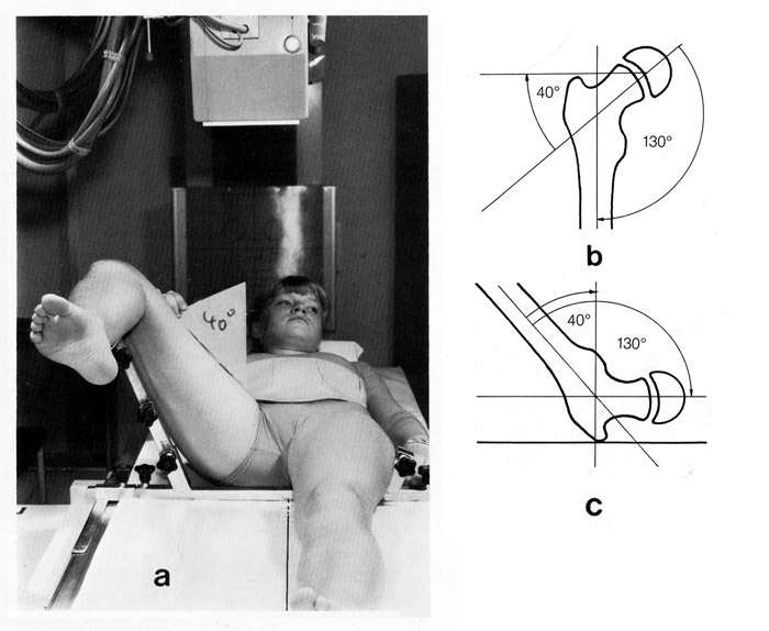 hip radiograph dunn view 2