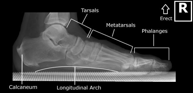 foot lateral weight bearing