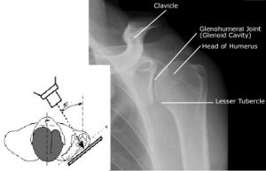 CE4RT - Radiographic Positioning of the Shoulder for X-ray Techs