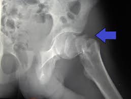 magnitude of bone health issues hip fracture