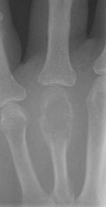 bone disease and causes tumor