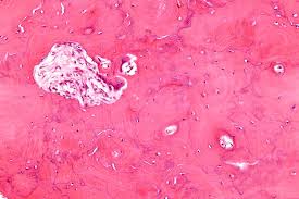 bone diseases in humans paget's