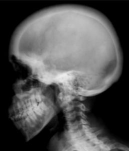 bone diseases in humans renal osteodystrophy