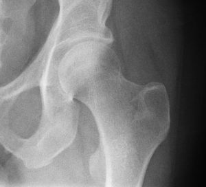 osteogenesis imperfecta types fracture