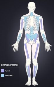 bone tumors radiology ewing's