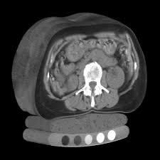 advantages of DXA scan versus QCT