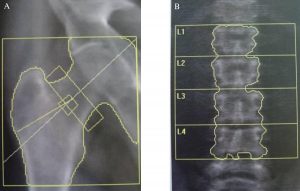 DXA scan errors analysis