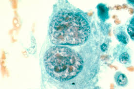 Osteosarcoma