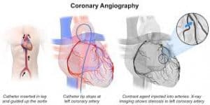 cardiac screening guidelines coronary angiography
