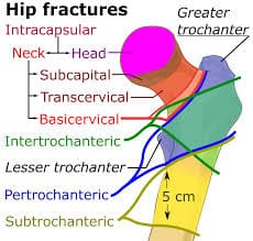 osteoporosis fracure risk