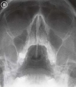 mastoid air cells x ray