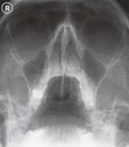 radiographic positioning of the face and mandible