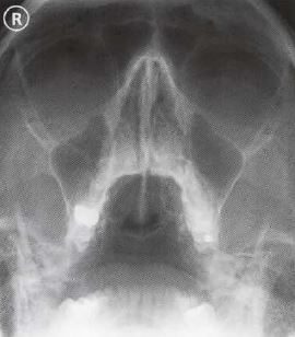 external auditory meatus x ray