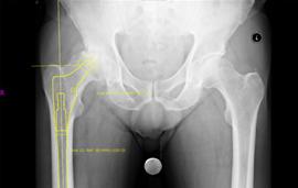 orthopedic template software