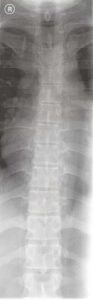 thoracic spine AP