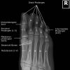 CE4RT - Radiographic Positioning of the Toes - A Guide for X-ray Techs