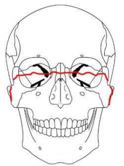 zygomatic arch x ray positioning