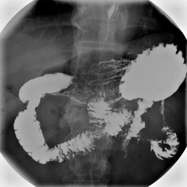 barium meal