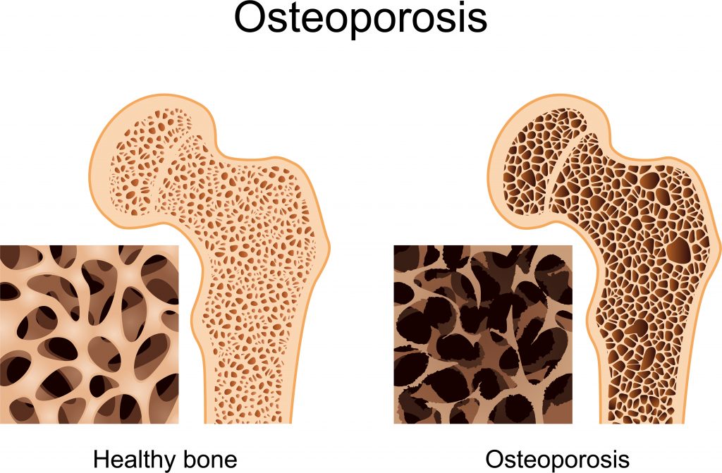 Bone Health and Osteoporosis Prevention: Challenges in the United States