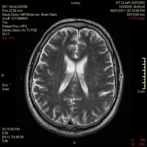 MRI of the brain